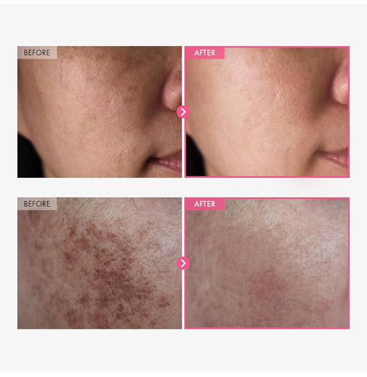 Arbutin 7% + crema de ácido tranexámico al 4%, 70,000 ppm de arbutina, 40,000 ppm TXA, niacinamida, glutatión, manchas oscuras, pecas, manchas, pigmentación, cuidado de la piel coreano