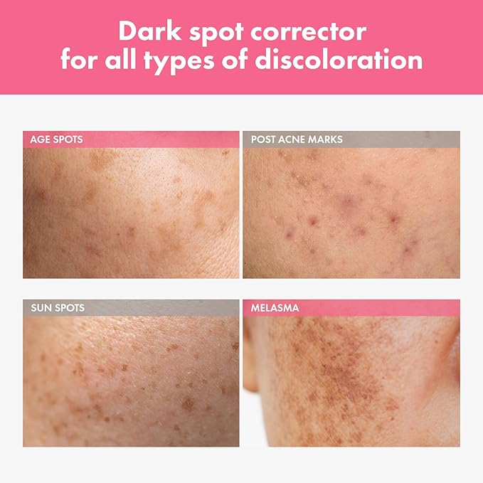 Arbutin 7% Crema intensiva para manchas con 70,000 ppm de arbutina, 3% ácido tranexámico, 1% niacinamida, glutatión, manchas oscuras, pecas, manchas, antipigmentación
