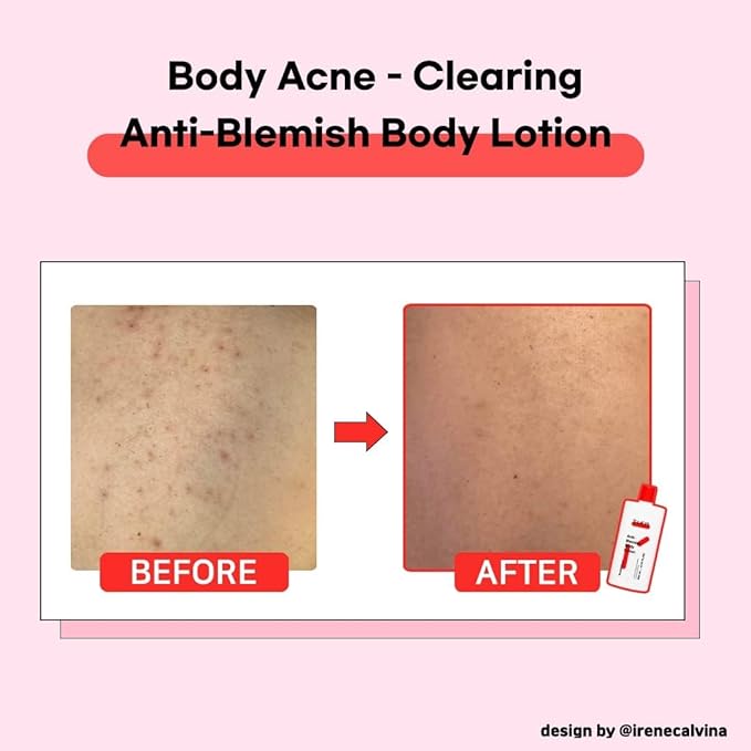 TIAM Loción corporal antimanchas, 6.76 onzas líquidas, loción corporal ligera para el acné con AHA, BHA, niacinamida para bacné, glúteos, acné en el pecho, cuidado de la piel coreano